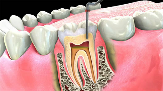 بیمه دندانپزشکی، کارت تخفیف دندانپزشکی