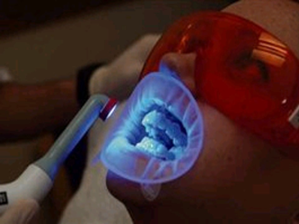 نانوذراتی برای از بین بردن پلاکت‌های دندان تولید شده است