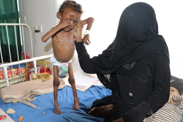 سیستم‌ ایمنی بدن گرسنگان یمن در حال فروپاشیدن است