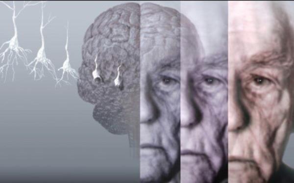 نوعی نانوکمپلکس به درمان بیماری آلزایمر کمک می‌کند
