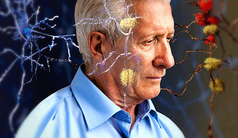آلزایمر سموم بدن را به مغز می‌رساند