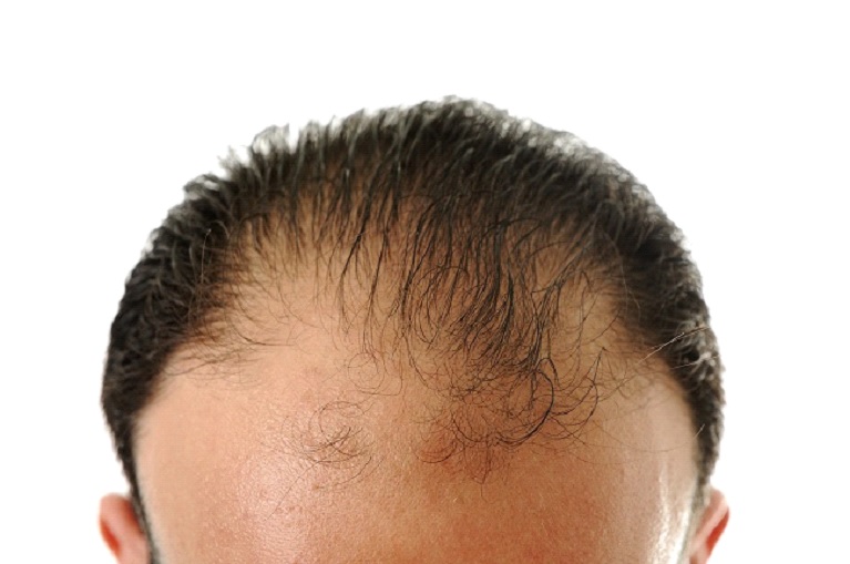 ۵ روش جلوگیری از ریزش مو و درمان آن