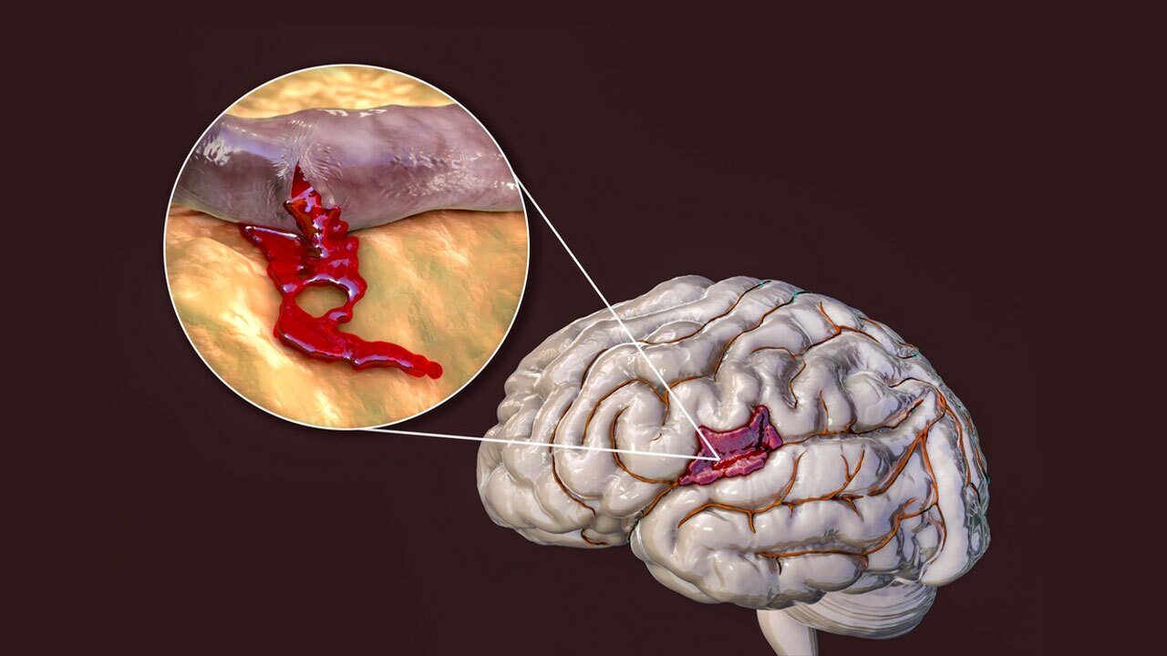 پاکسازی خون‌ریزی در مغز با یک ابزار قابل کنترل