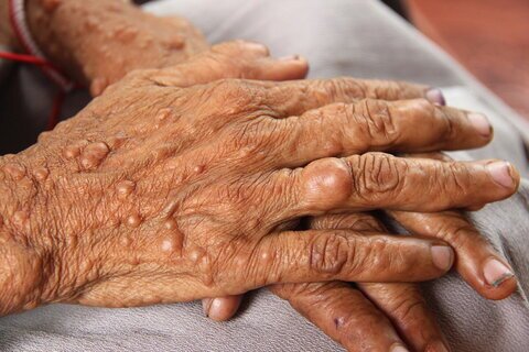 لزوم افزایش حمایت از مبتلايان به بیماری&zwnj;های نادر در کرمان