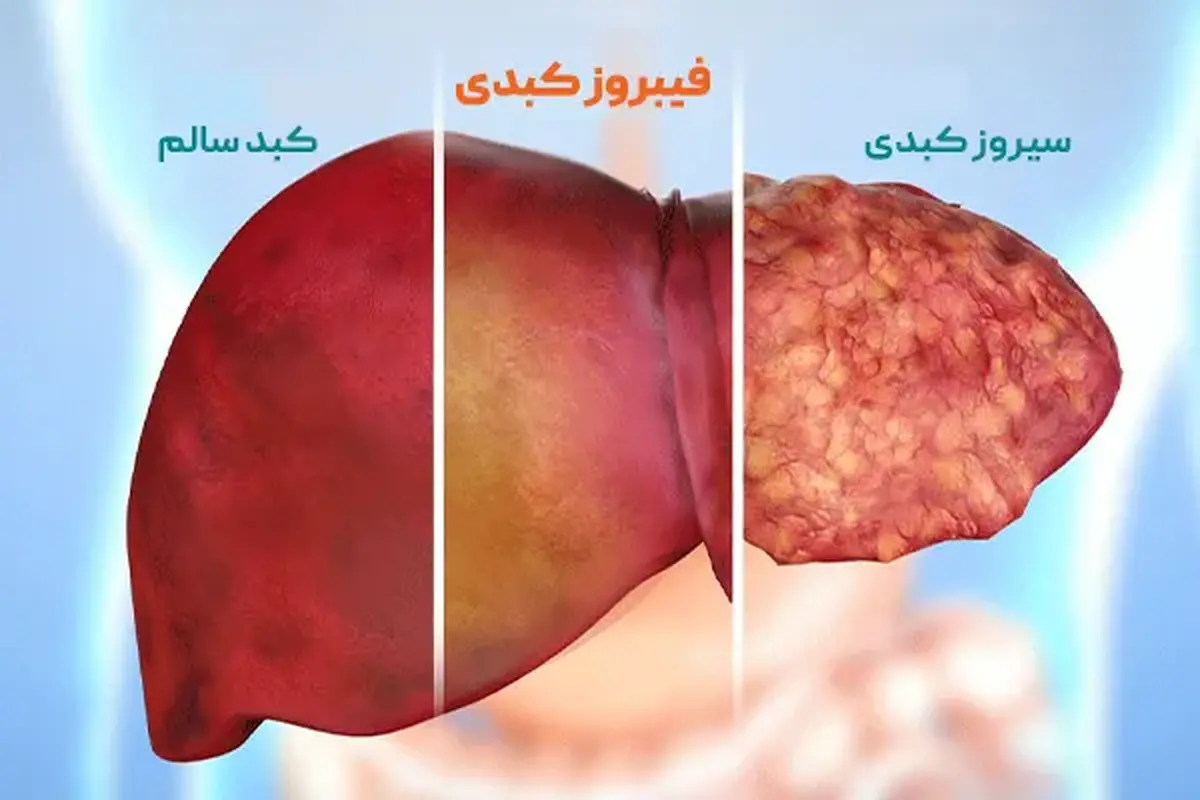 کشف آنزیمی که فیبروز مرگبار کبد را متوقف و معکوس می‌کند
