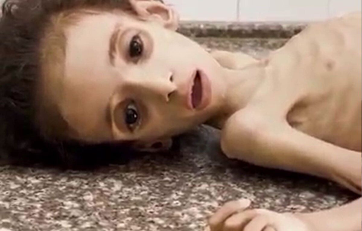 شهادت تلخ کودک ۴ ساله بر اثر سوءتغذیه