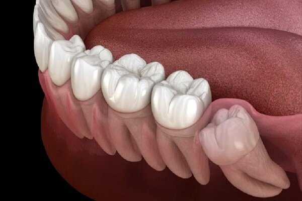ارتباط سلامت ضعیف دهان و دندان با مشکلات مزمن سلامت