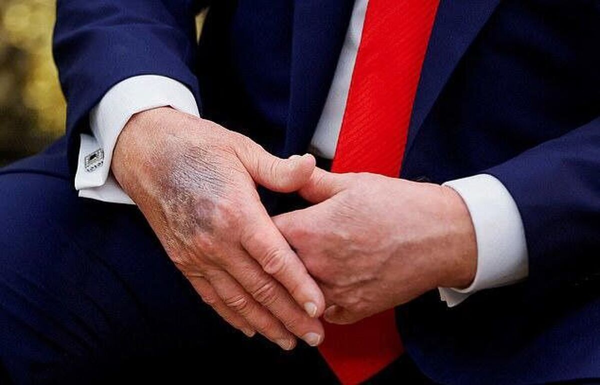 این بیماریها ترامپ را به سمت مرگ میبرد