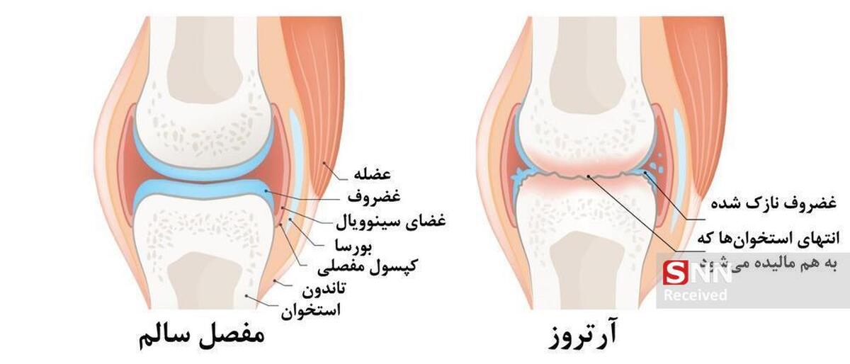 پیاده‌روی، دوچرخه‌سواری و شنا راه موثر مقابله با آرتروز