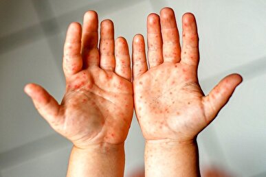 سرخک دوباره بازگشته چون واکسن را به علت باورهای غلط جدی نگرفتیم