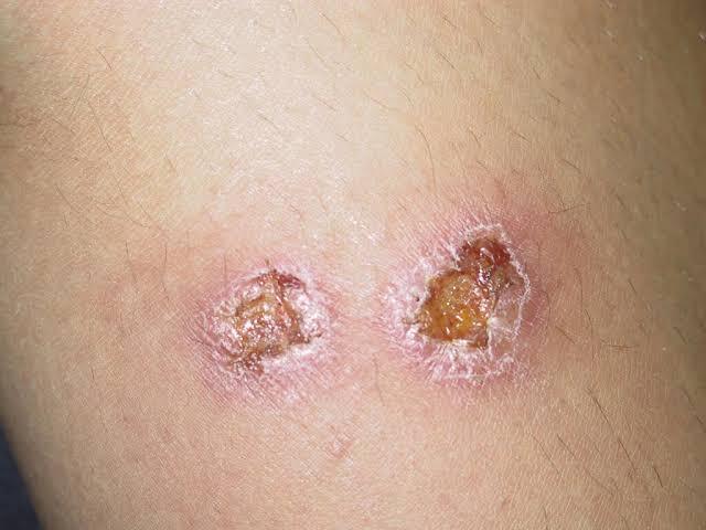 نخستین باند تخصصی درمان زخم سالک توسط محققان کاشانی تولید شد