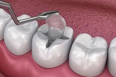 تحول در جراحی دندان‌پزشکی؛ اسفنج ژلاتینی نوآورانه با سه عملکرد حیاتی همزمان