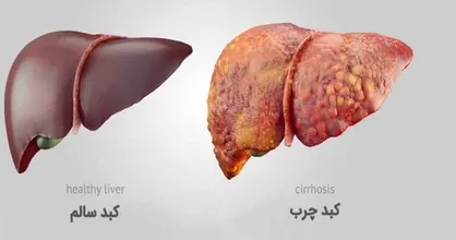 هدیه ماه رمضان به روزه&zwnj;دارانی که کبد چرب دارند