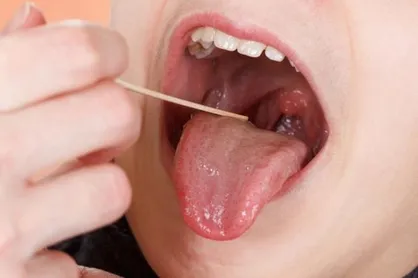 نقش لوزه&zwnj;ها در سیستم ایمنی بدن