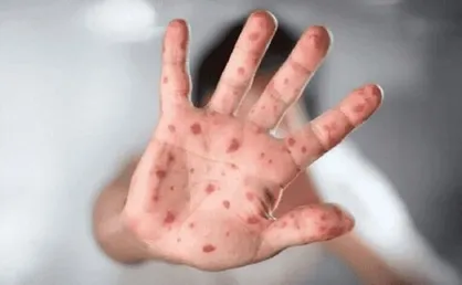 انتقال آبله میمونی فقط از طریق تماس پوستی ممکن است / نه واکسن نه مراقبت خاص؛ فقط قرنطینه + فیلم