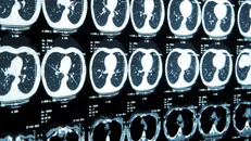 MRI نانویی می‌تواند سرطان را زودهنگام شناسایی کند
