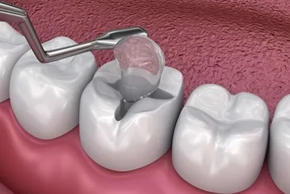 تحول در جراحی دندان&zwnj;پزشکی؛ اسفنج ژلاتینی نوآورانه با سه عملکرد حیاتی همزمان