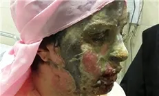 اسیدپاشی وحشیانه به دختر جوان/ بیمه هزینه درمان را نپرداخت +عکس
