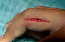 درمان زخم نیاز به کار گروهی و تیمی دارد / زخم‌هایی که می‌تواند سبب مرگ بیمار شود