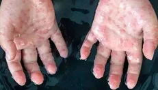 شناسایی موارد جدید ابتلا به آبله میمونی در امارات