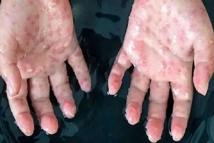 مراقبت مرزی برای مقابله با آبله میمون / مشکلی درتشخیص بیماری نداریم