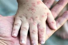 سرخک یکی از مسری‌ترین بیماری‌ها