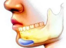 درصد قابل توجهی از افراد جامعه مبتلا به مشکلات مزمن مفاصل فکی می‌باشند