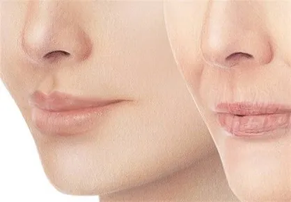 با لاغری صورت&zwnj;مان چه کنیم؟ / راهکارهایی برای پر و چاق کردن صورت