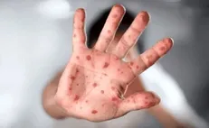 عدم فراگیری آبله میمونی در ایران / ویروس تاکنون جهش خطرناکی نداشته