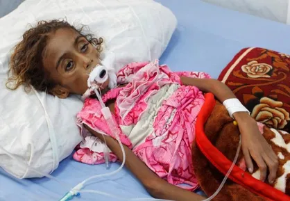 وزیر بهداشت یمن: سازمان ملل ۲ بار کودکان یمنی را به قتل رساند