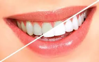 خونریزی لثه نشانه چیست؟ / نقش بزاق دهان در جرم سازی دندان