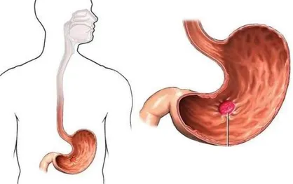بهترین و بدترین غذا&zwnj;ها برای زخم معده را بشناسید