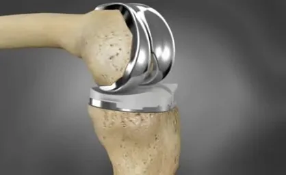 پروتز&zwnj;های زیستی جایگزین استخوان قابل کاشت در بدن می&zwnj;شوند