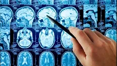 همکاری پژوهشگران ایرانی و جامعه جهانی در حوزه مغز گسترش یافت