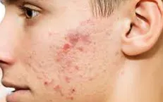 ۷ راهکار برای جلوگیری از جوش زدن صورت