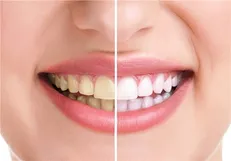 پوشش نانوذره‌ای مانع پوسیدگی دندان‌ها می‌شود