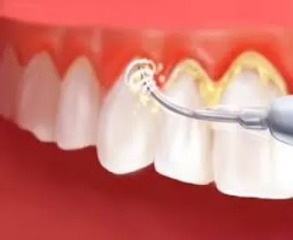 جرم گیری دندان چرا و چگونه؟