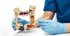بررسی علل سرطان کولورکتال و روش‌های جلوگیری از عود آن