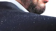 نانومواد ایرانی شما را از شر شوره سر خلاص می‌کند