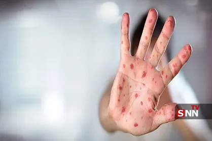نیویورک به دلیل شیوع سرخک وضعیت اضطراری اعلام کرد