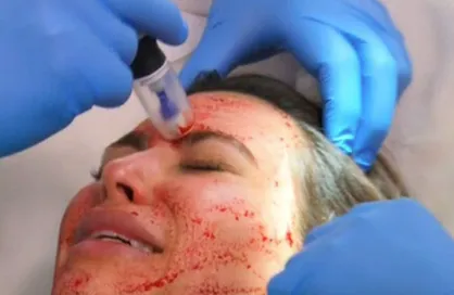 هشدار درباره عوارض جوان&zwnj;سازی صورت توسط افراد غیر متخصص