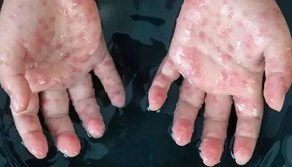 ابتلای ۶۲ هزار نفر به آبله میمونی در ۱۰۵ کشور