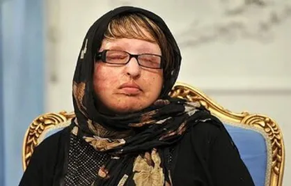 اظهارات تکان&zwnj;دهنده آمنه بهرامی ؛ بعد از اسیدپاشی باز هم تهدید می شدم / حکایت مجازات جنایتکار در ازدواج و بخشش قربانی
