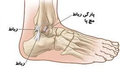 ارائه روش&zwnj;های نوین جراحی&zwnj;های پا و مچ پا/ دلیل افتادگی مچ پا و انگشتان