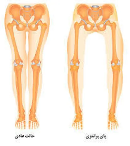 اغلب آسیایی&zwnj;ها دچار پای پرانتزی هستند
