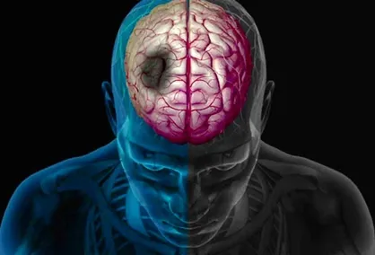 چگونه زمستان خطر سکته مغزی را افزایش می&zwnj;دهد؟
