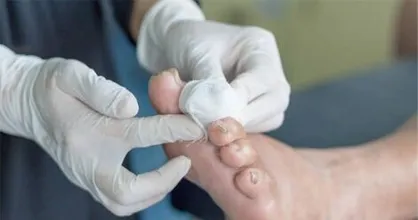 راه&zwnj;اندازی و فعالیت مرکز پلاسما&zwnj;درمانی زخم&zwnj;های دیابتی در بیمارستان امام علی (ع) کرج