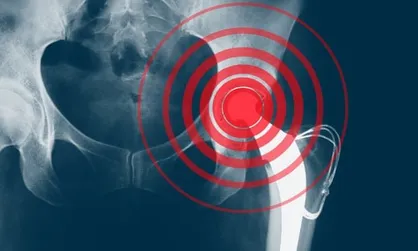 ۳ توصیه کلیدی درباره پوکی استخوان