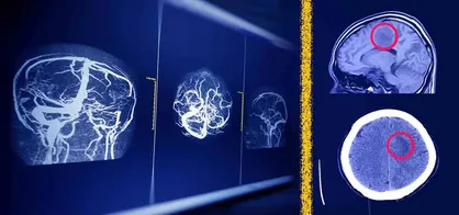 راه&zwnj; حل جدید پژوهشگران دانشگاه تهران برای افزایش امنیت هوش مصنوعی در تحلیل MRI مغز