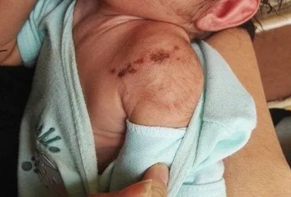 کودک آزاری به سبک گازگرفتن +عکس